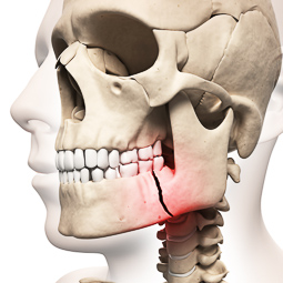 Facial Trauma - Athens Oral Surgery Center