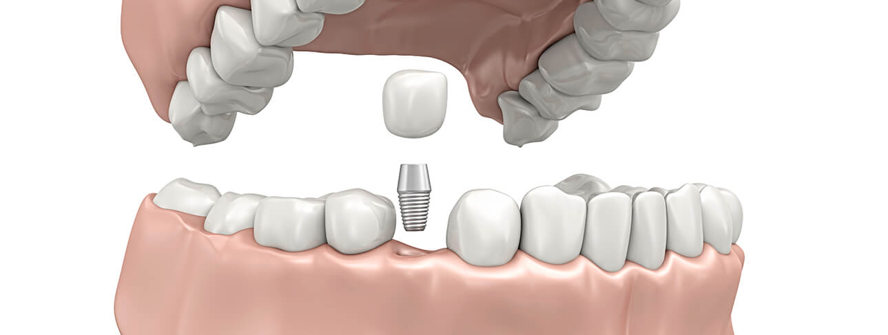 3d image of a tooth implant that screws into a socket