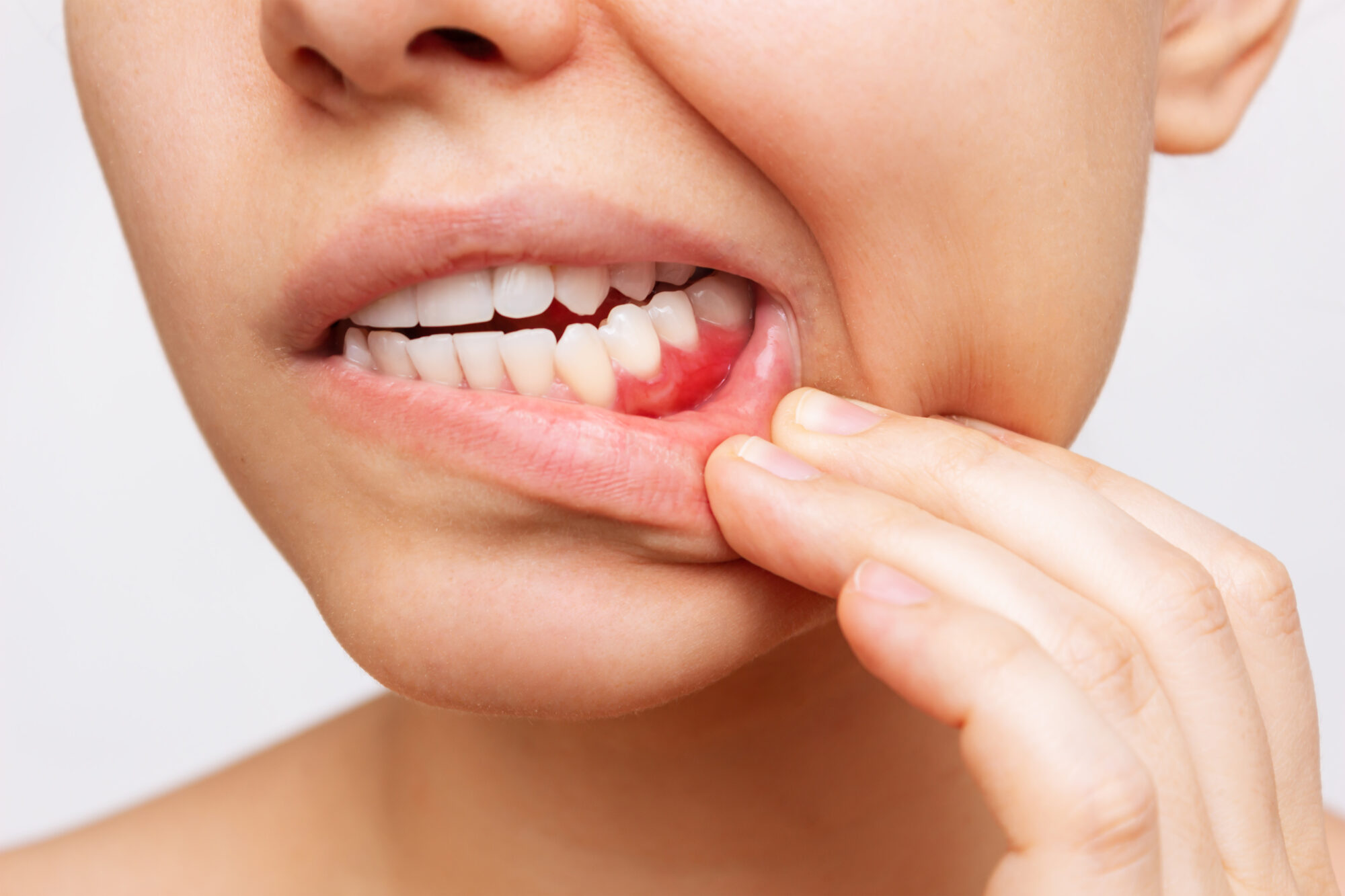 What Does Gum Disease Look Like? - Athens Oral Surgery Center