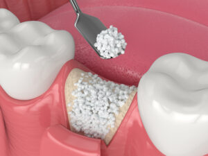 3D render of dental bone grafting with bone biomaterial applicat