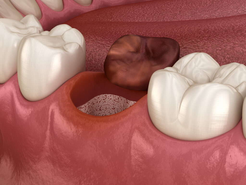 Alveolits - opened dry soket after tooth extraction. Medically accurate 3D illustration