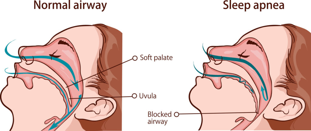 Illustration comparing a person sleeping without sleep apnea on the left to someone sleeping with sleep apnea on the right. The image on the right shows how sleep apnea causes airways to become obstructed.